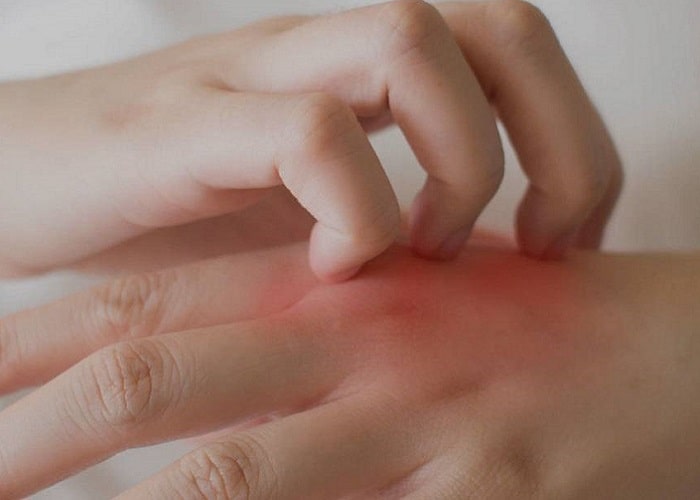 آیا اگزمای دست، درمان دارد؟ علائم و علت اگزمای پوست دست در خانم ها