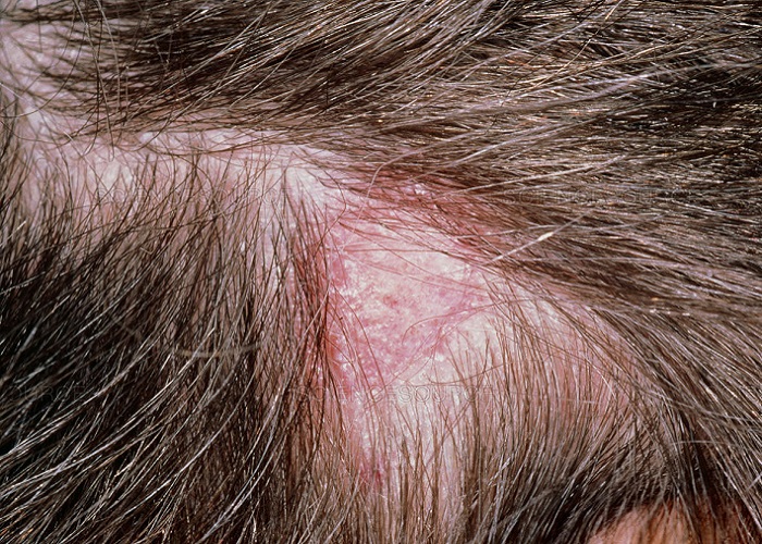 قارچ پوست سر، تاثیرات آن بر ریزش مو و راه های درمانی قارچ سر