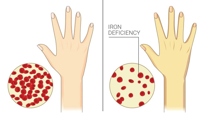 7 Signs of chronic iron deficiency most women ignore 1200x675 1