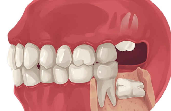 Cost wisdom tooth removal