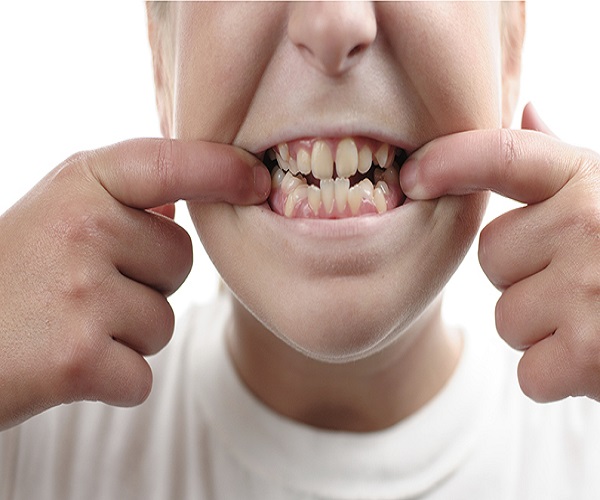 دندان اضافه یا نهفته از علت تا درمان